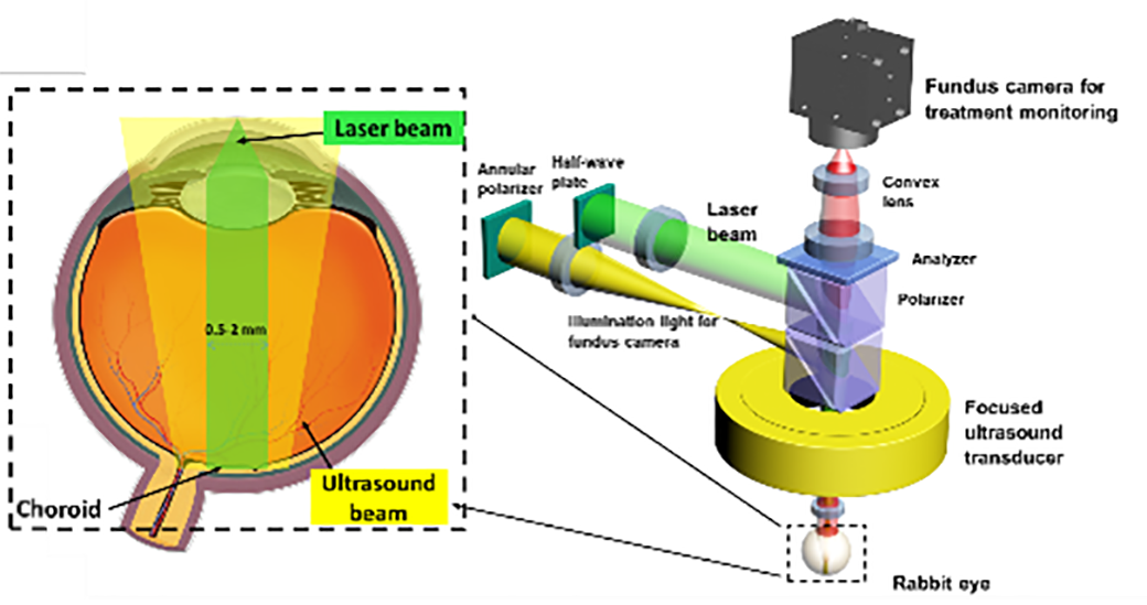 Diagram of the application of photo mediated ultrasound therapy to an eye