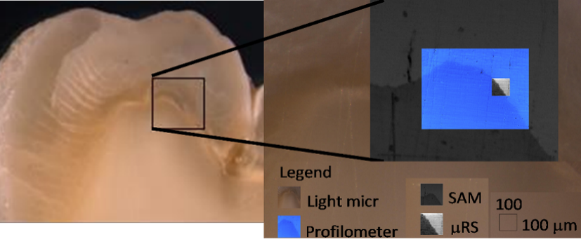 Composite image of data collected using scanning acoustic microscopy (elastic properties) and micro-Raman spectroscopy for molecular-structure characterization. Data are overlain on the optical image to indicate location on the specimen for data acquisition.