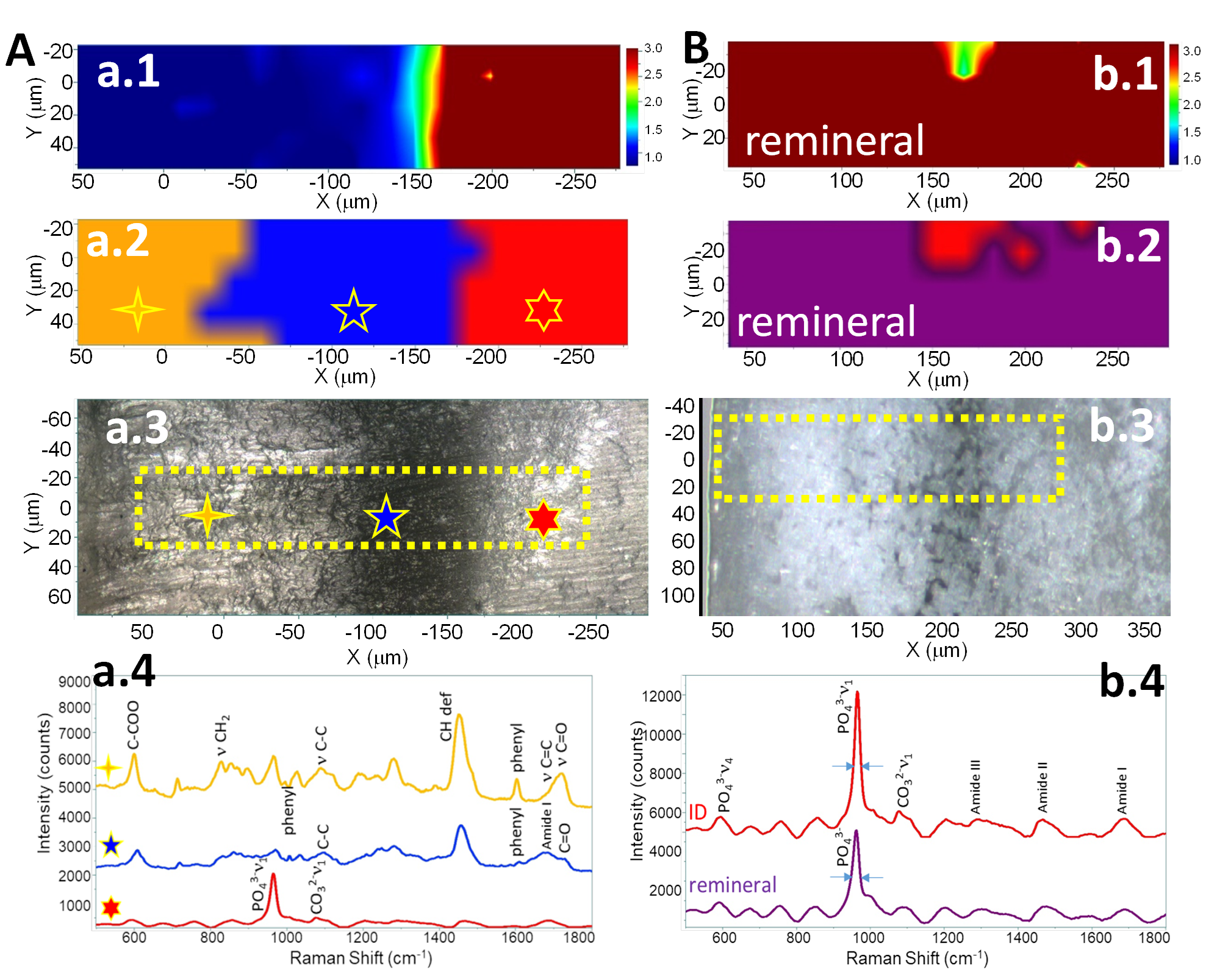 RAMAN analysis of adhesive/dentin interface before remineralization 